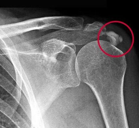 A radiografia mostrou depósitos de sais de cálcio na articulação