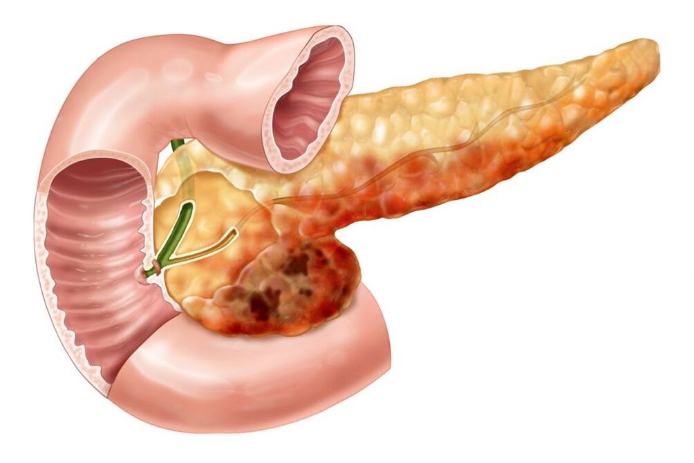 dor nas costas devido a pancreatite