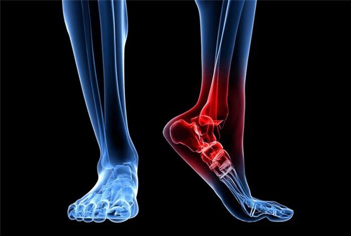 artrose do pé