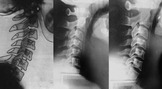 Pescoço com um deslocamento da primeira vértebra cervical