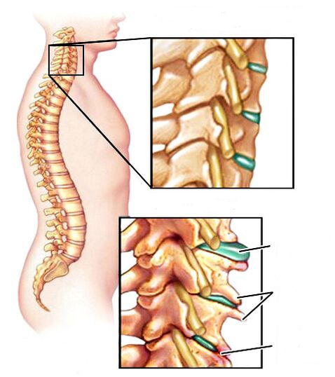 Como é a osteocondrose