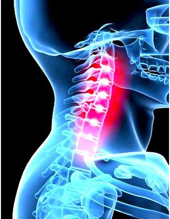 Imagem clínica da osteocondrose