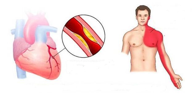 Síndrome de Cardial